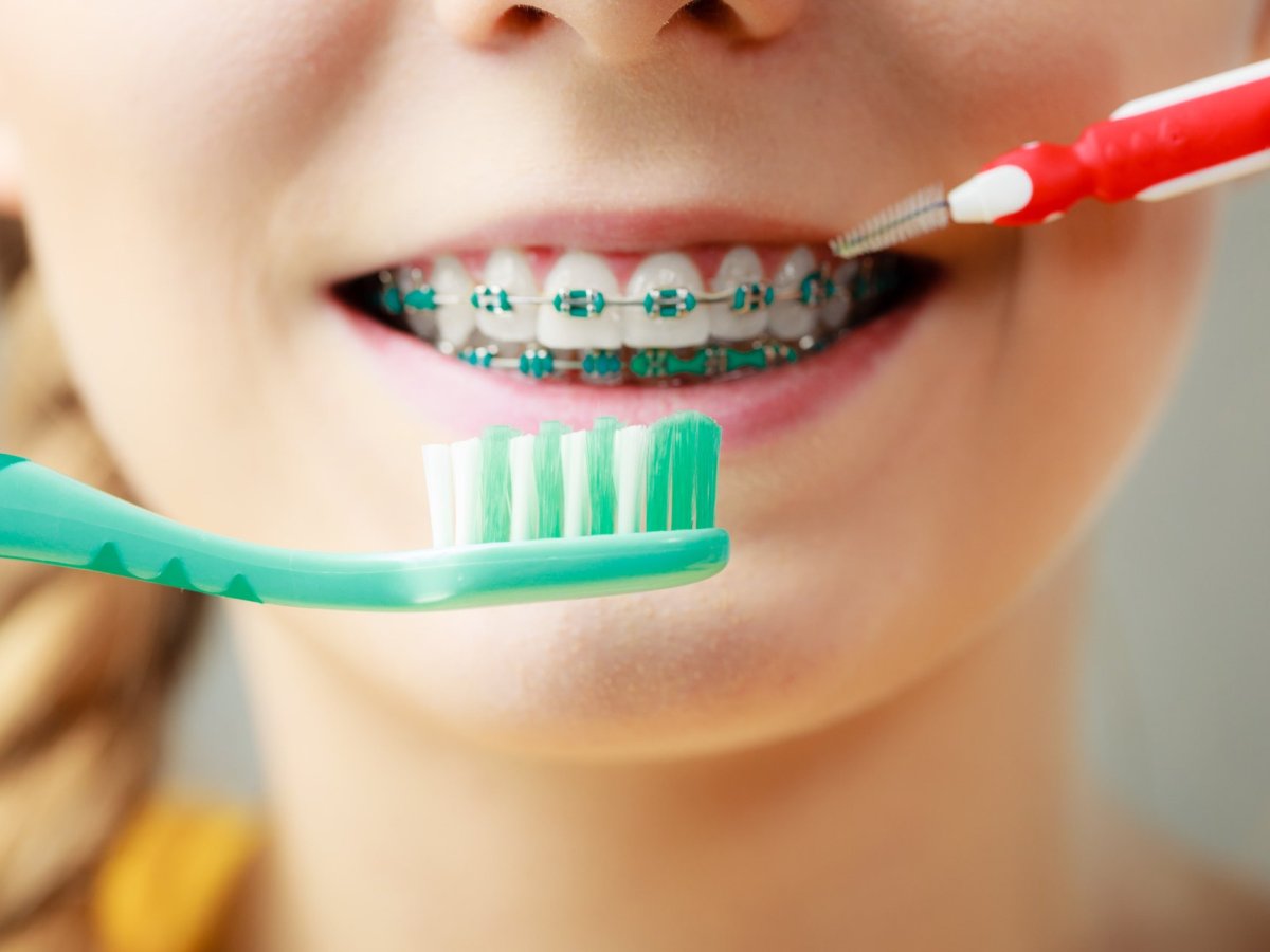 How to take care of your teeth with&nbsp;braces